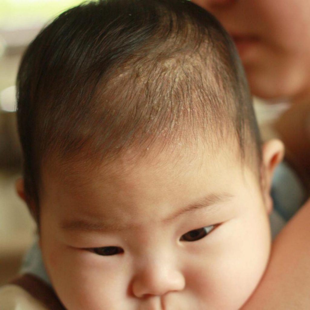 How To Clean Cradle Cap for Infants care for newborn hair and skin
